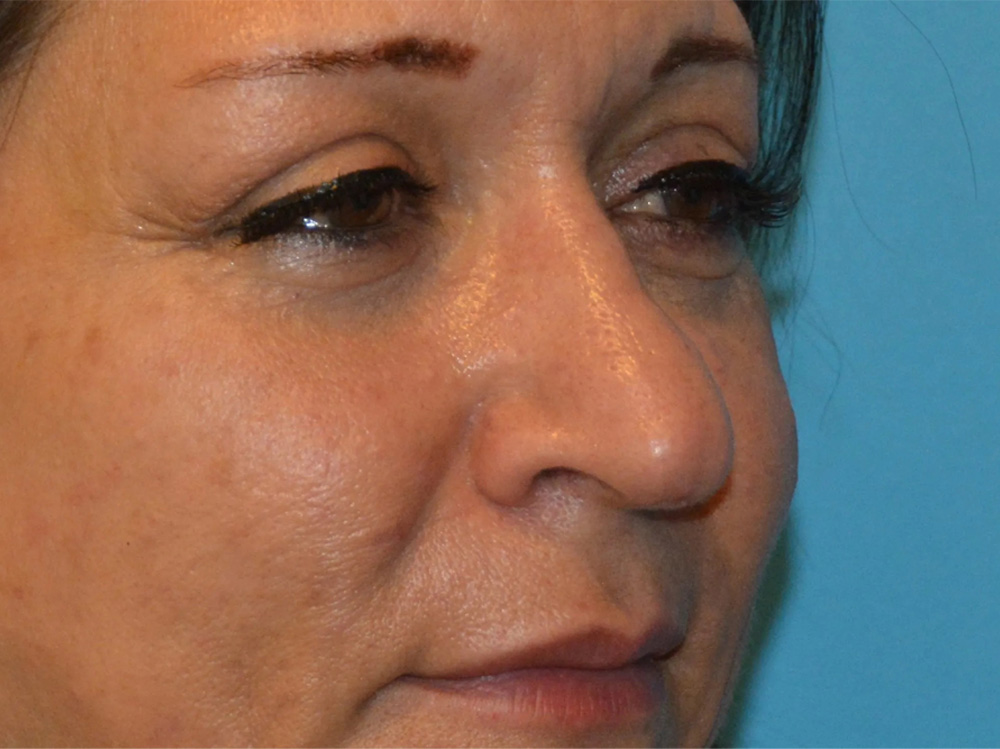 Cheek Implants Real Patient Results by Dr. Scott Urban in Salt Lake City, Utah