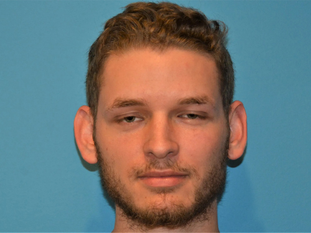 Cheek Implants Real Patient Results by Dr. Scott Urban in Salt Lake City, Utah