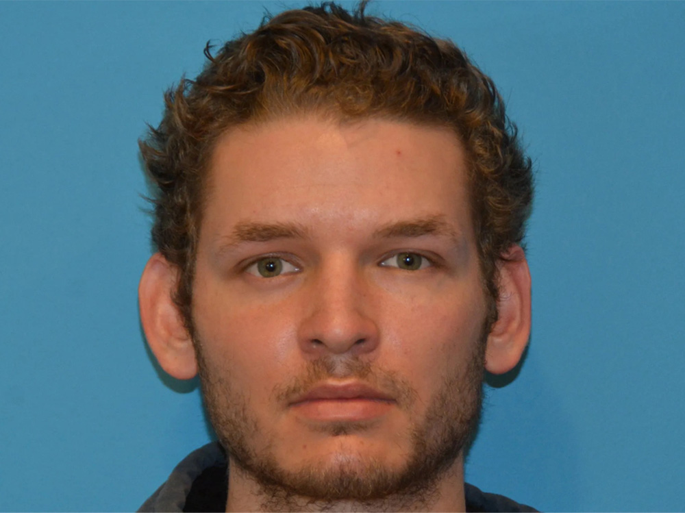 Cheek Implants Real Patient Results by Dr. Scott Urban in Salt Lake City, Utah