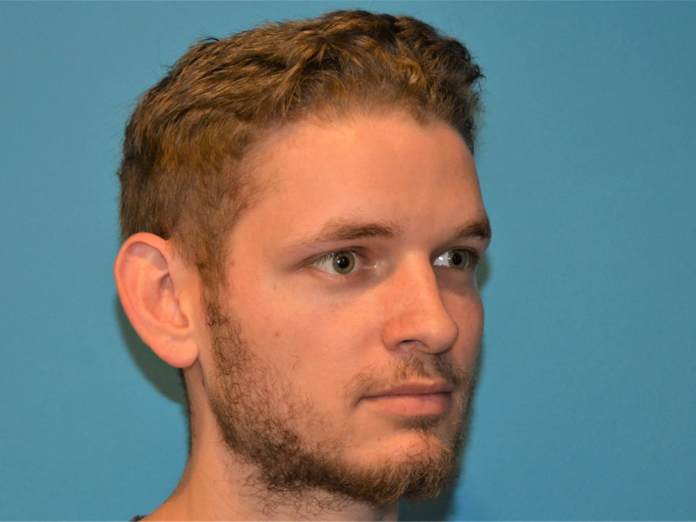 Cheek Implants Real Patient Results by Dr. Scott Urban in Salt Lake City, Utah