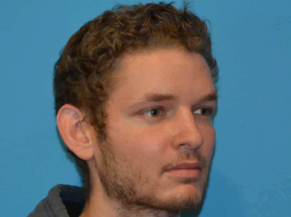 Cheek Implants Real Patient Results by Dr. Scott Urban in Salt Lake City, Utah