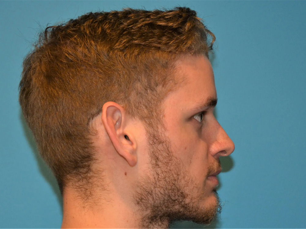 Cheek Implants Real Patient Results by Dr. Scott Urban in Salt Lake City, Utah