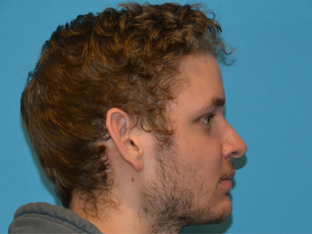 Cheek Implants Real Patient Results by Dr. Scott Urban in Salt Lake City, Utah