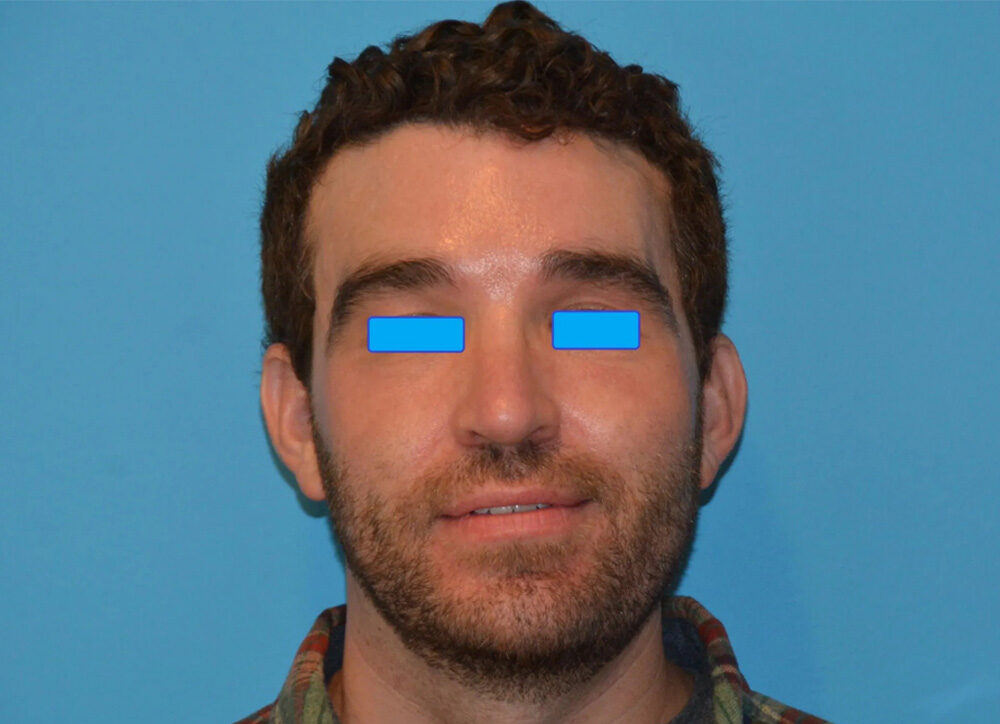 Cheek Implants Real Patient Results by Dr. Scott Urban in Salt Lake City, Utah