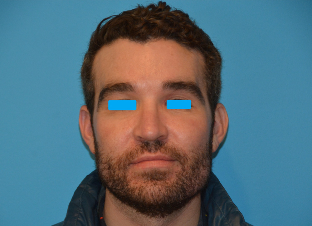 Cheek Implants Real Patient Results by Dr. Scott Urban in Salt Lake City, Utah