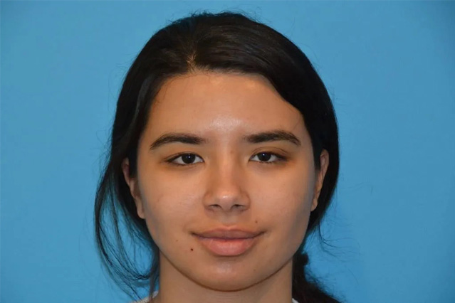 Chin Implants Real Patient Results by Dr. Scott Urban in Salt Lake City, Utah