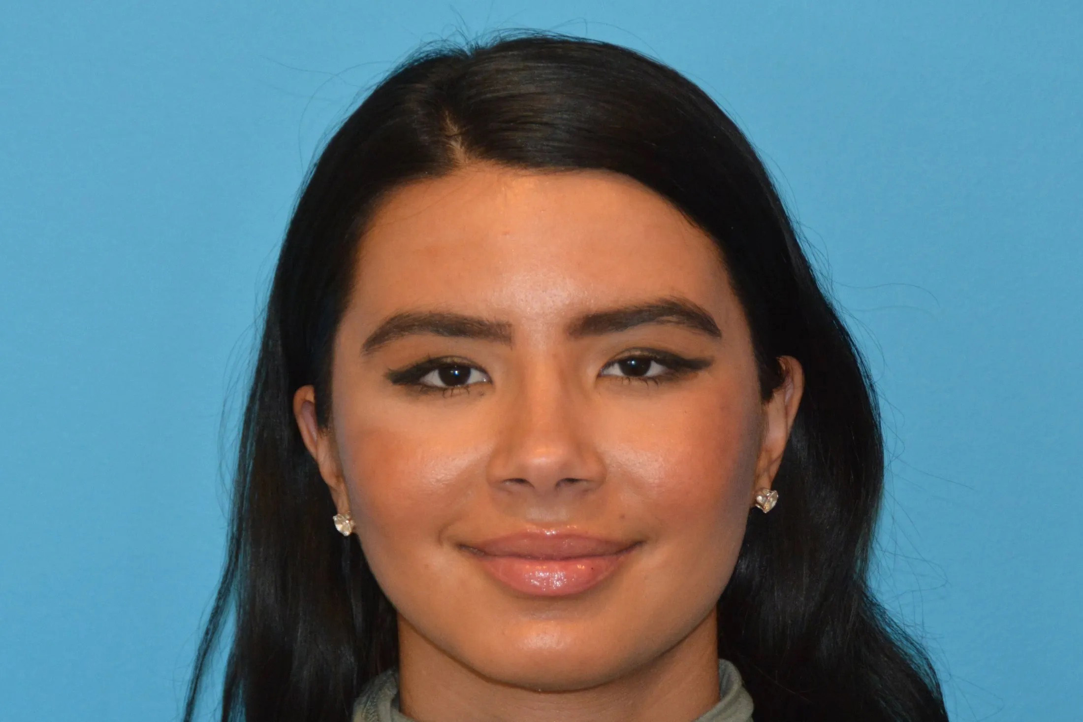 Chin Implants Real Patient Results by Dr. Scott Urban in Salt Lake City, Utah