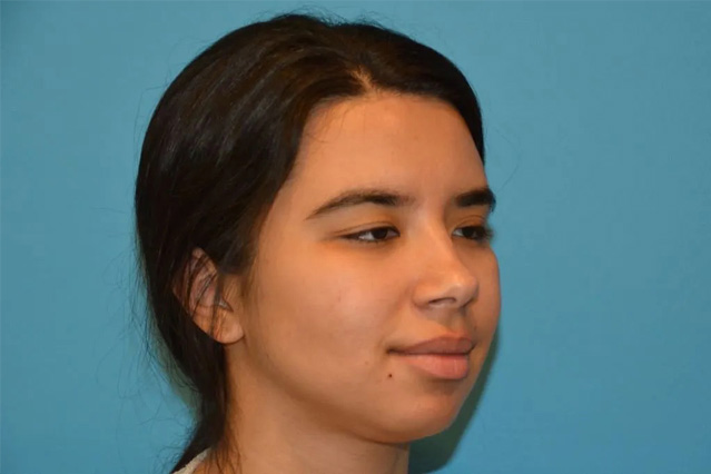 Chin Implants Real Patient Results by Dr. Scott Urban in Salt Lake City, Utah