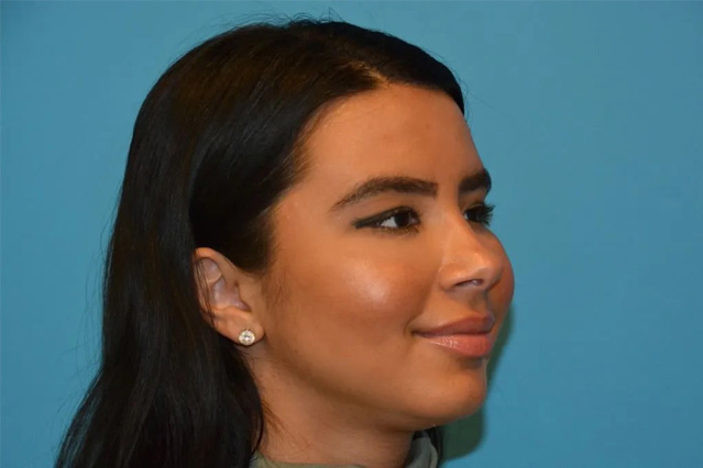 Chin Implants Real Patient Results by Dr. Scott Urban in Salt Lake City, Utah