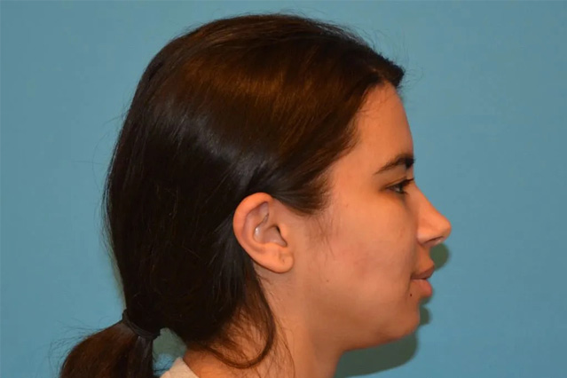 Chin Implants Real Patient Results by Dr. Scott Urban in Salt Lake City, Utah