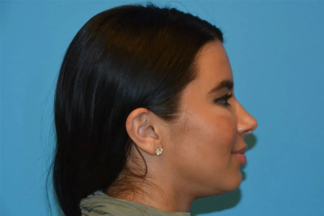 Chin Implants Real Patient Results by Dr. Scott Urban in Salt Lake City, Utah