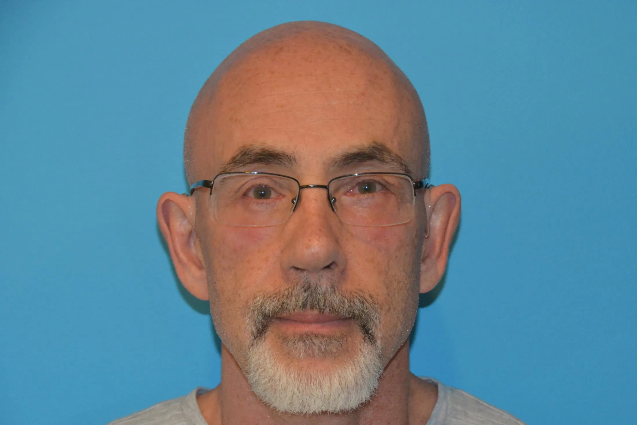 Chin Implants Real Patient Results by Dr. Scott Urban in Salt Lake City, Utah