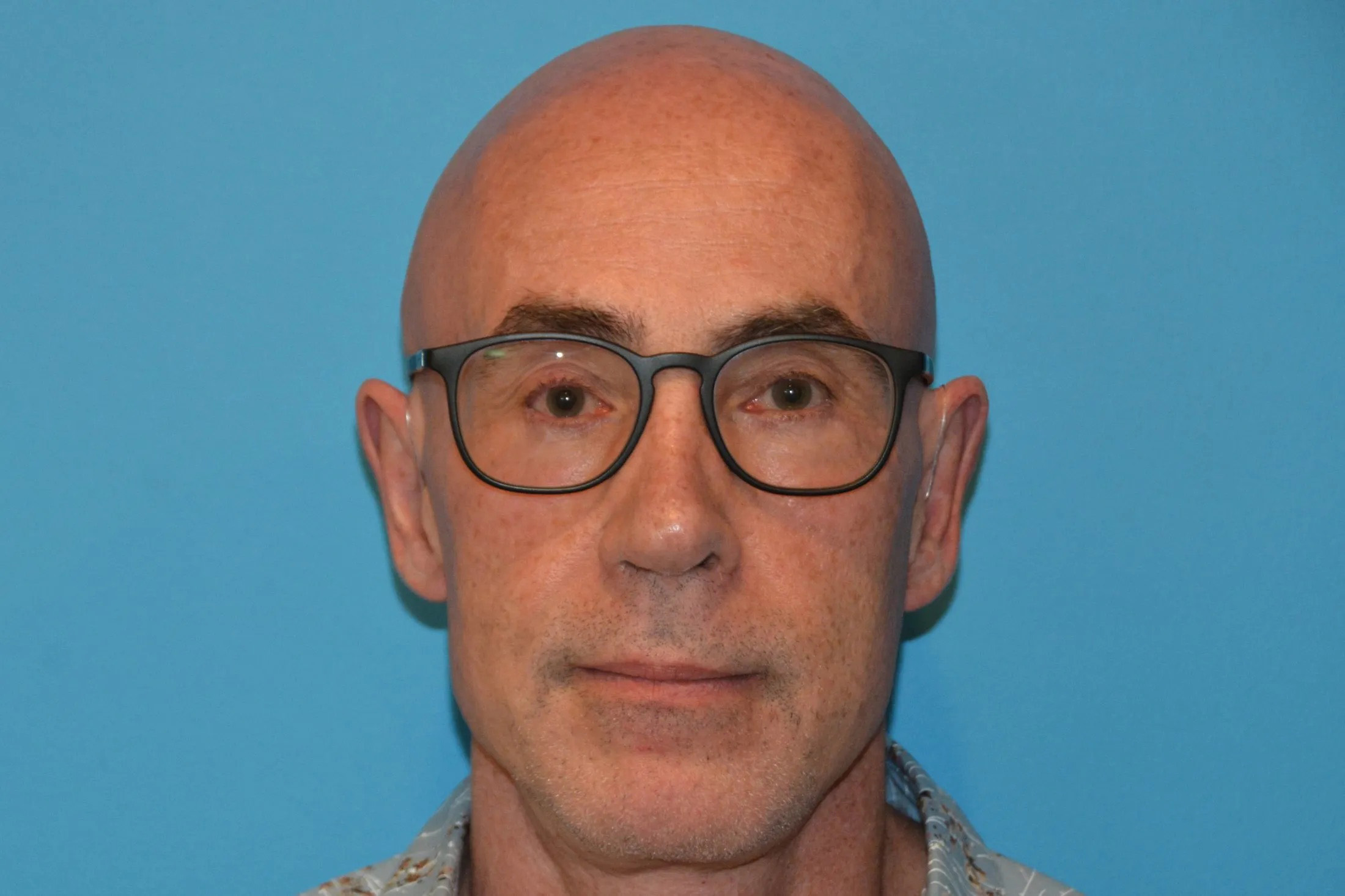 Chin Implants Real Patient Results by Dr. Scott Urban in Salt Lake City, Utah