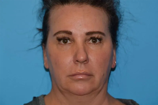 Chin Implants Real Patient Results by Dr. Scott Urban in Salt Lake City, Utah