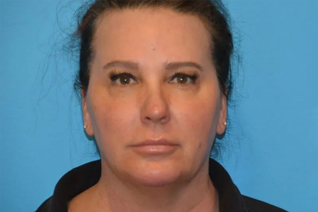 Chin Implants Real Patient Results by Dr. Scott Urban in Salt Lake City, Utah