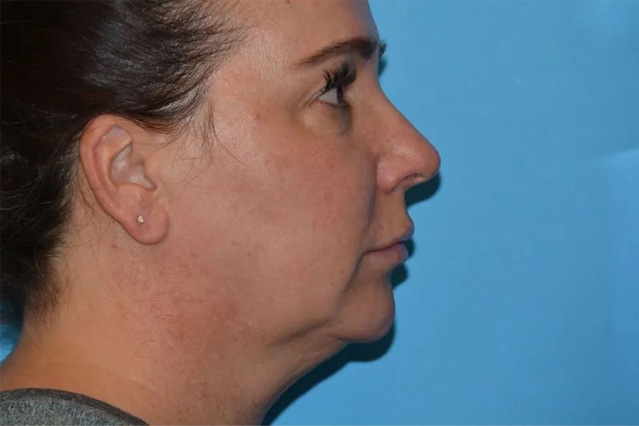Chin Implants Real Patient Results by Dr. Scott Urban in Salt Lake City, Utah