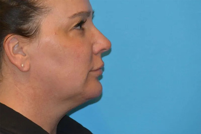 Chin Implants Real Patient Results by Dr. Scott Urban in Salt Lake City, Utah
