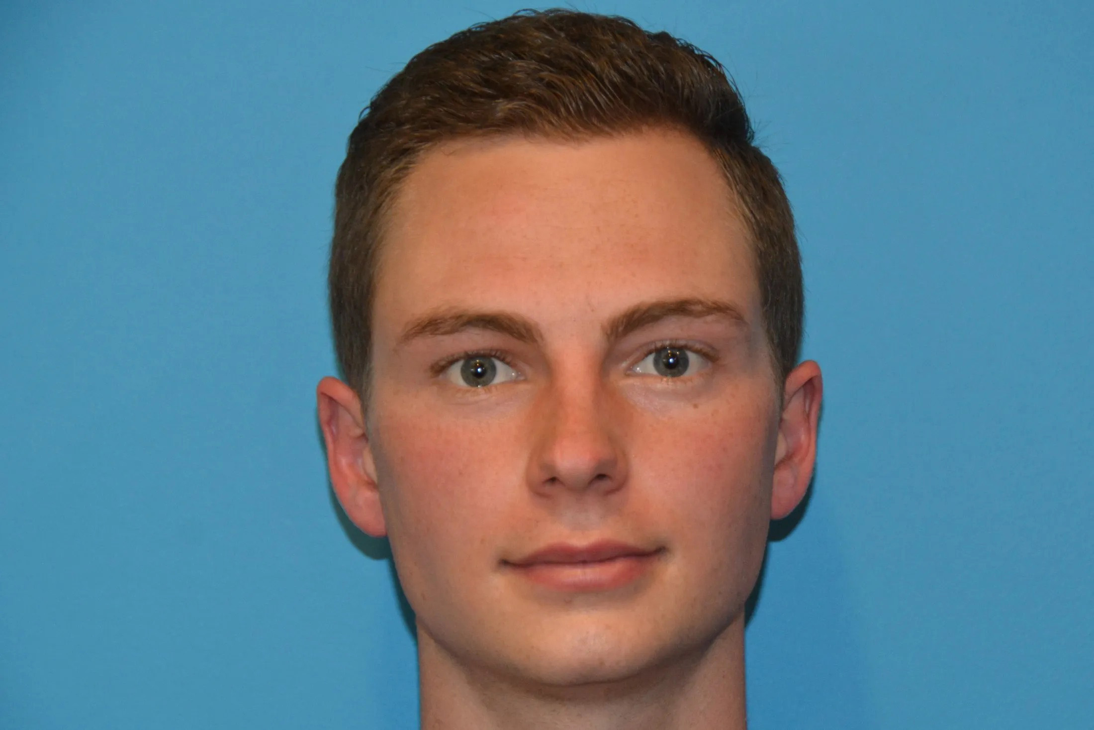 Chin Implants Real Patient Results by Dr. Scott Urban in Salt Lake City, Utah