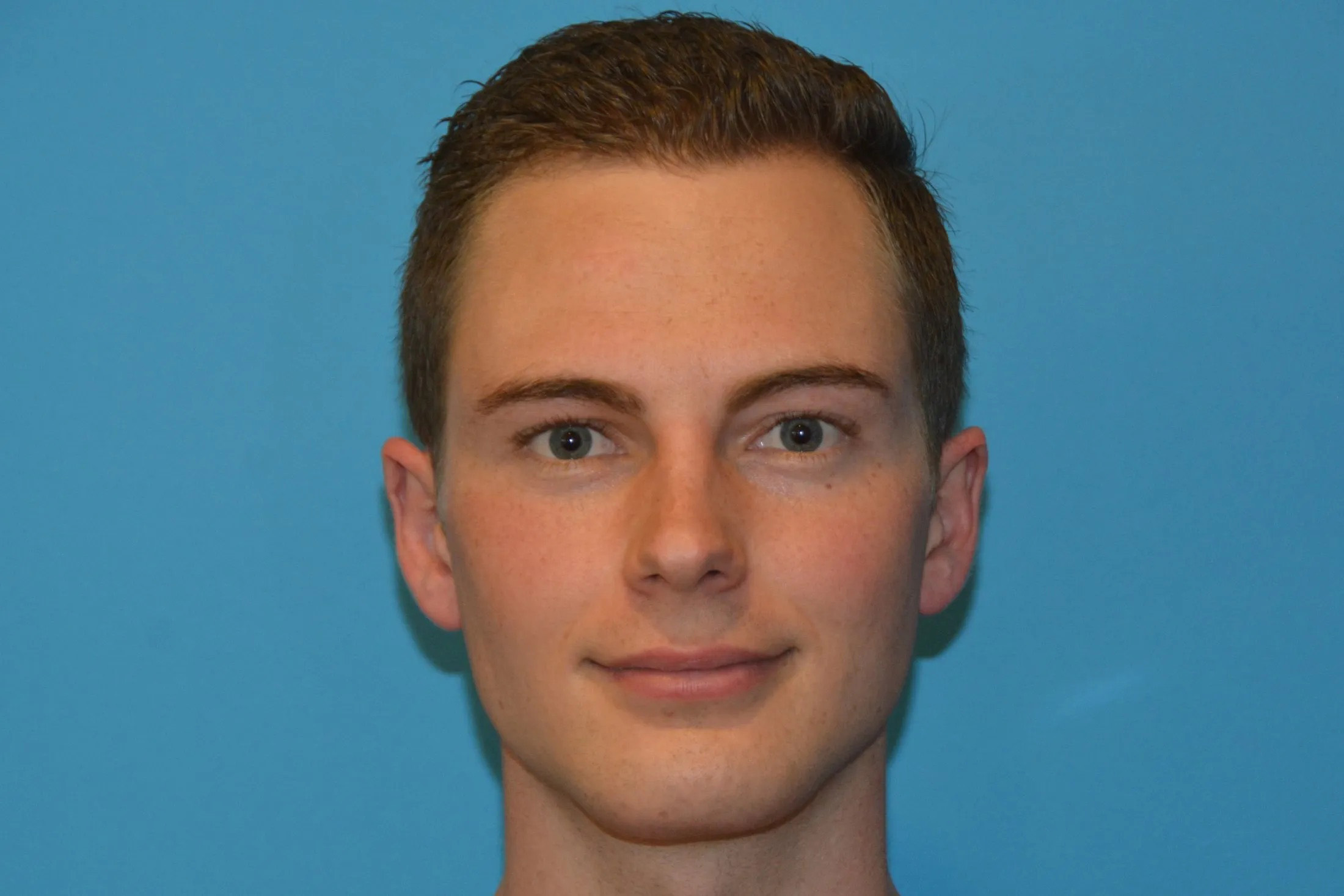 Chin Implants Real Patient Results by Dr. Scott Urban in Salt Lake City, Utah