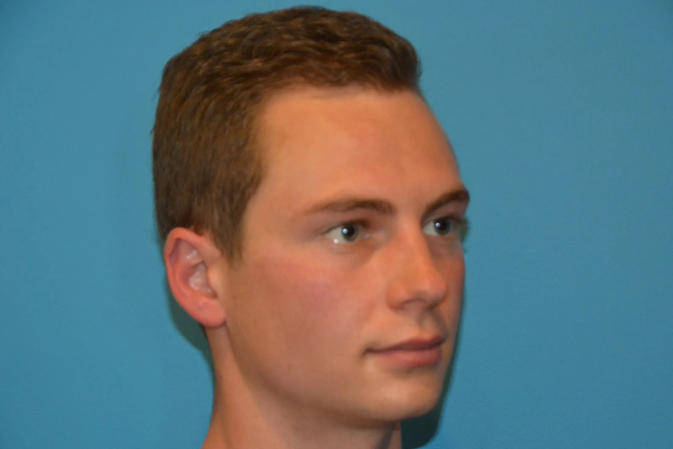 Chin Implants Real Patient Results by Dr. Scott Urban in Salt Lake City, Utah