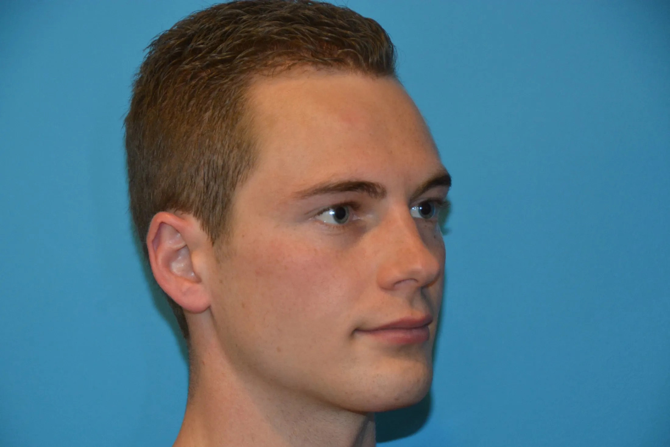 Chin Implants Real Patient Results by Dr. Scott Urban in Salt Lake City, Utah