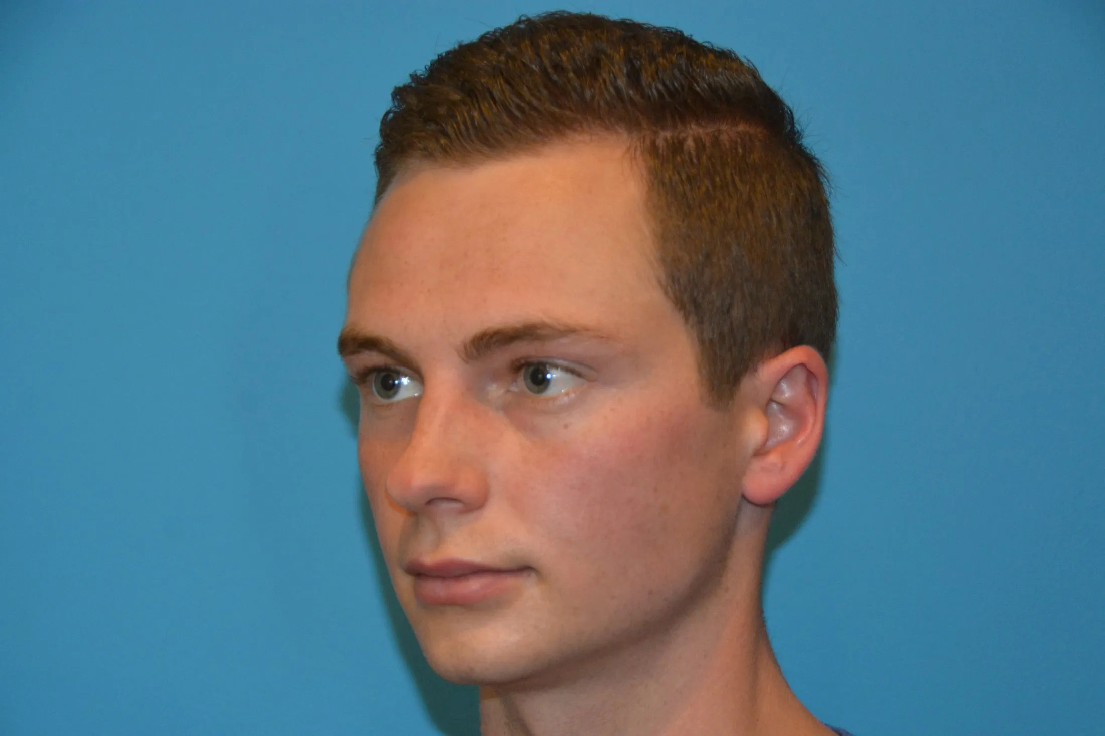 Chin Implants Real Patient Results by Dr. Scott Urban in Salt Lake City, Utah