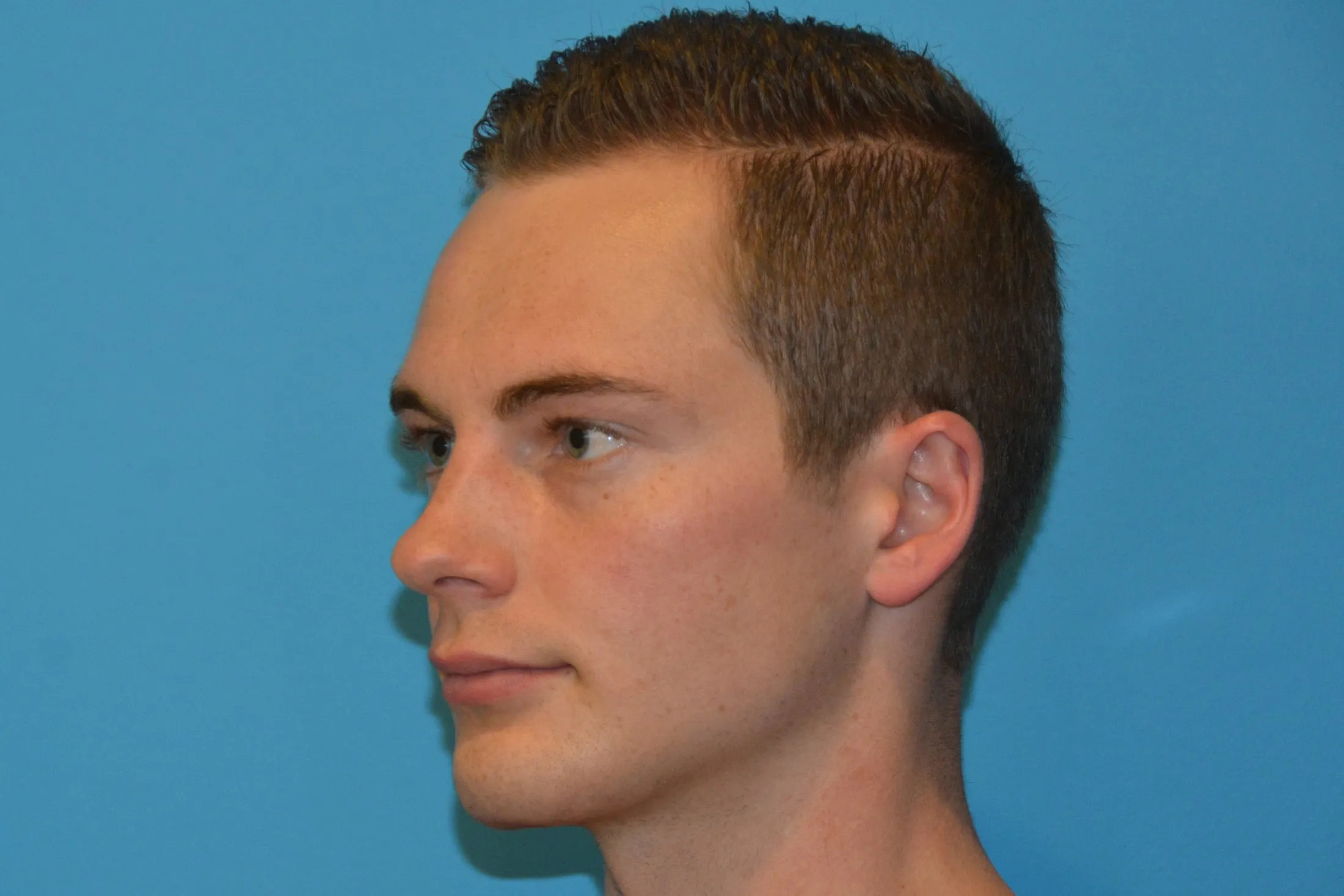 Chin Implants Real Patient Results by Dr. Scott Urban in Salt Lake City, Utah