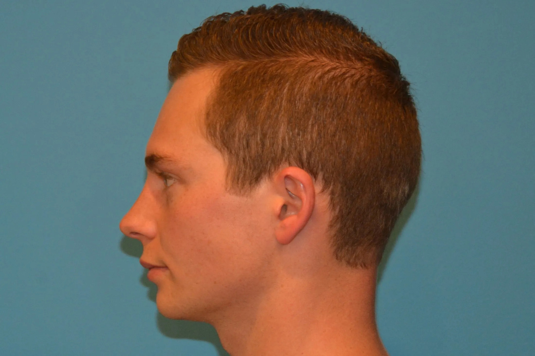 Chin Implants Real Patient Results by Dr. Scott Urban in Salt Lake City, Utah