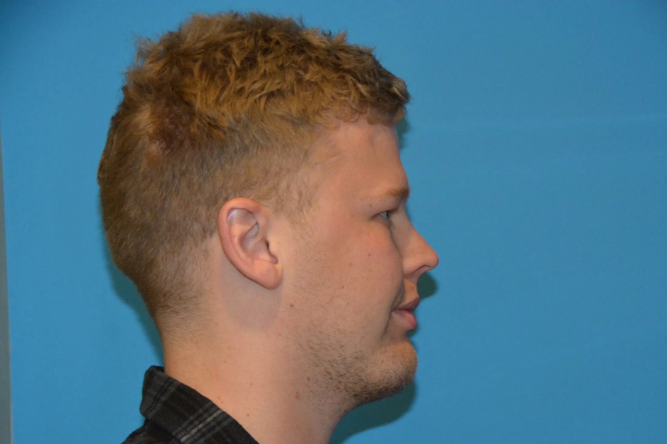 Chin Implants Real Patient Results by Dr. Scott Urban in Salt Lake City, Utah