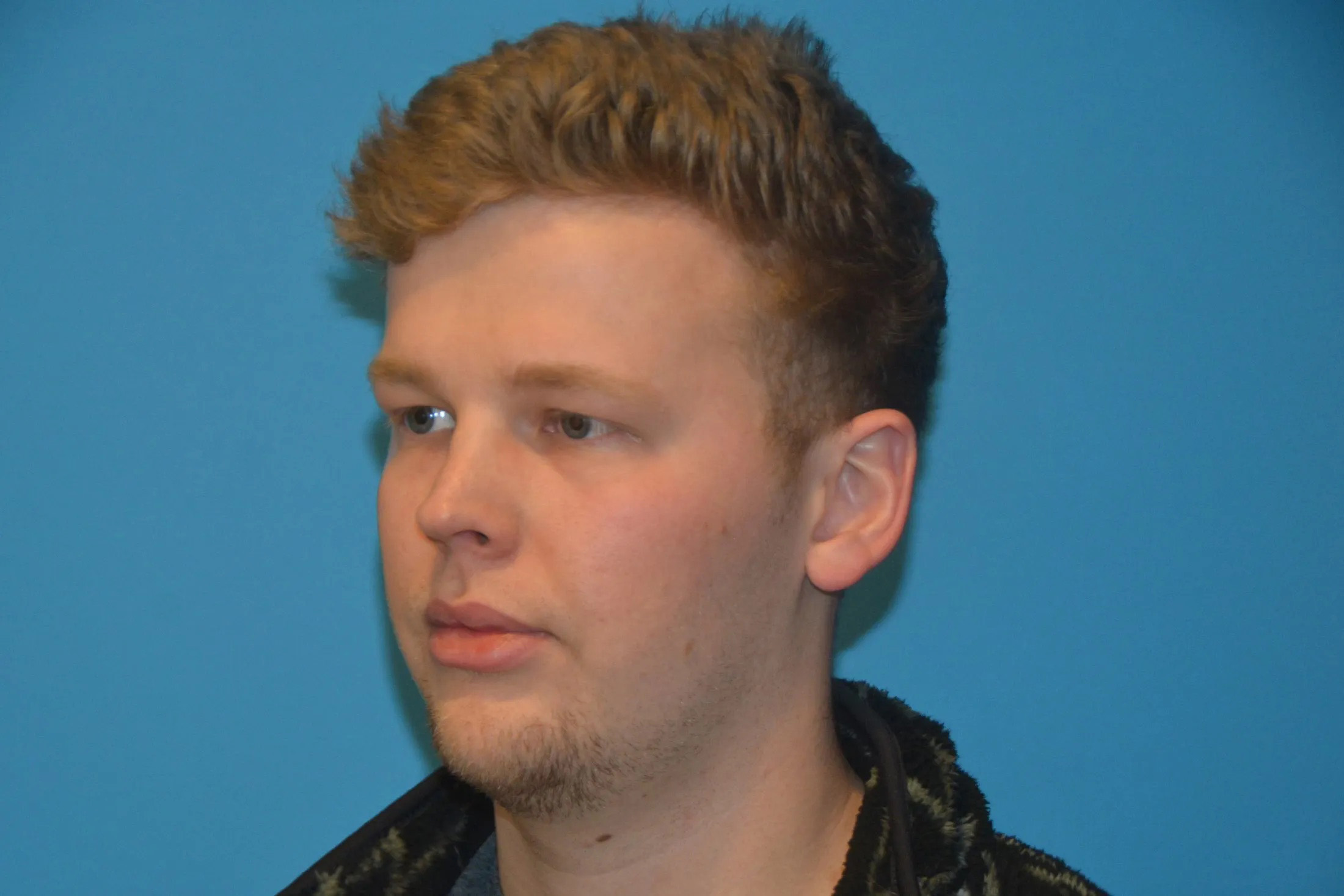 Chin Implants Real Patient Results by Dr. Scott Urban in Salt Lake City, Utah