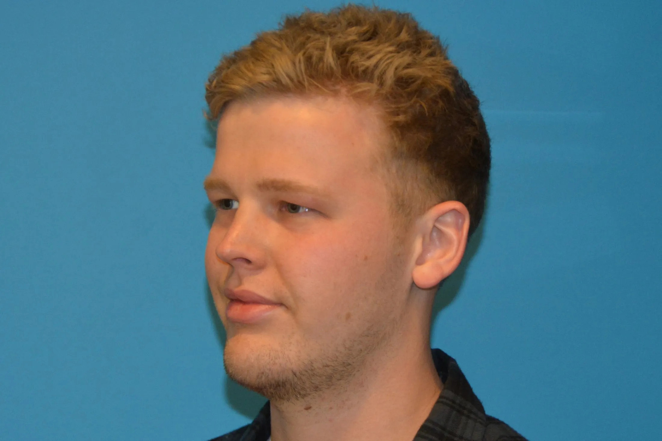 Chin Implants Real Patient Results by Dr. Scott Urban in Salt Lake City, Utah