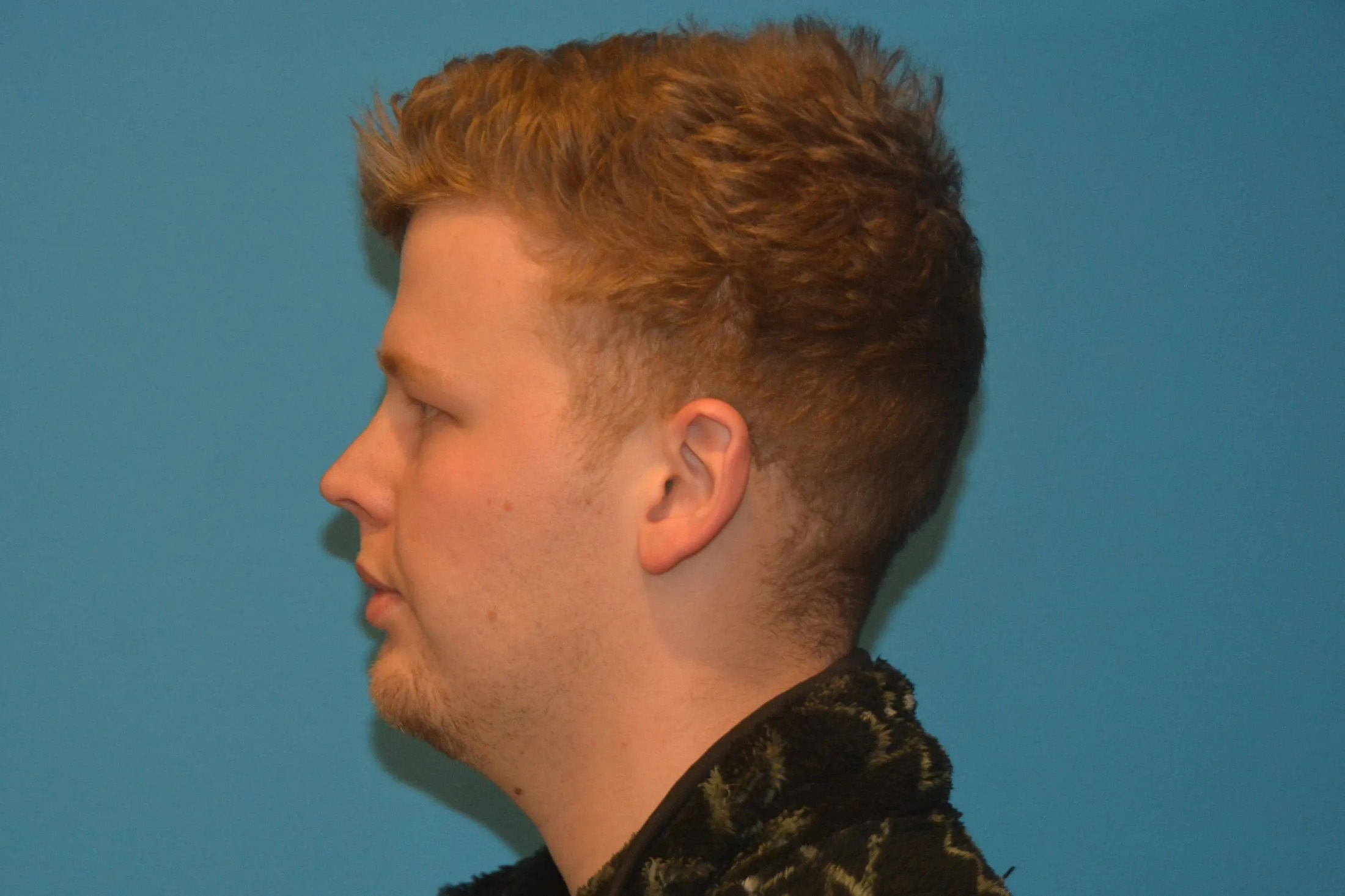 Chin Implants Real Patient Results by Dr. Scott Urban in Salt Lake City, Utah