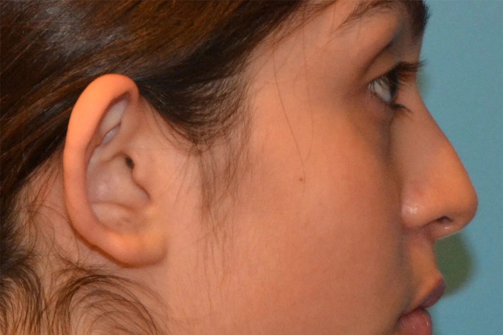 Ear Surgery Real Patient Results by Dr. Scott Urban in Salt Lake City, Utah