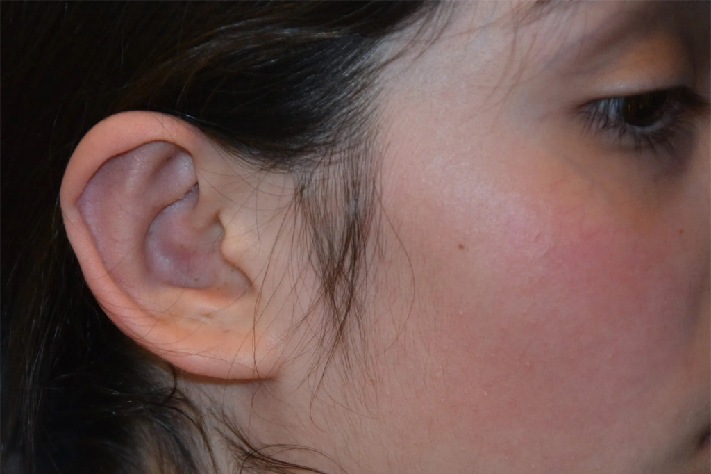 Ear Surgery Real Patient Results by Dr. Scott Urban in Salt Lake City, Utah