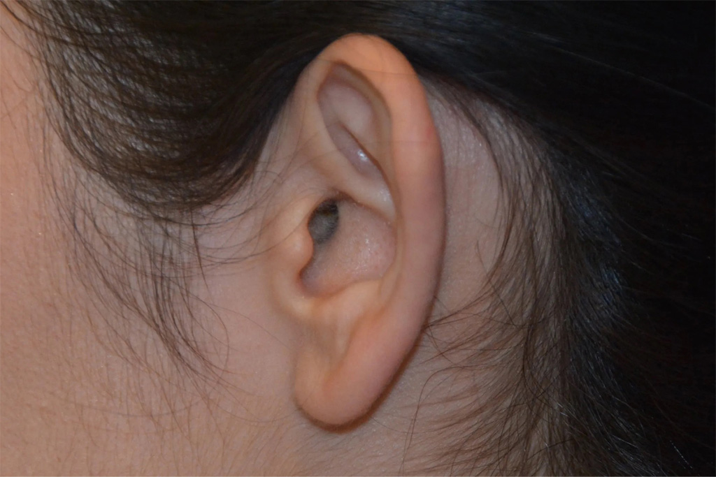 Ear Surgery Real Patient Results by Dr. Scott Urban in Salt Lake City, Utah