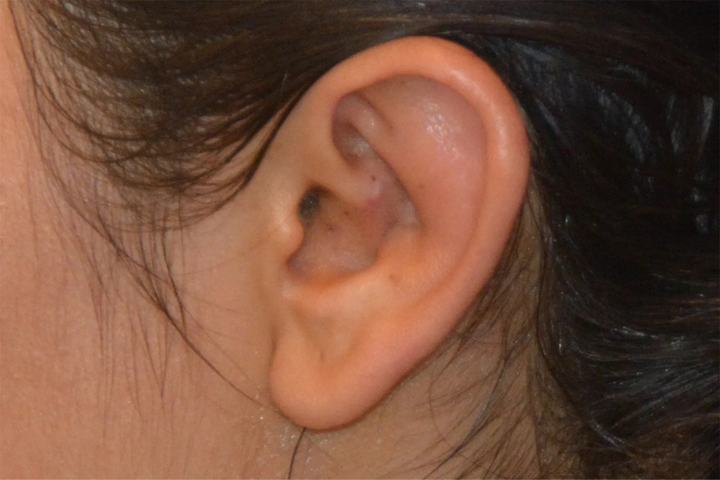 Ear Surgery Real Patient Results by Dr. Scott Urban in Salt Lake City, Utah