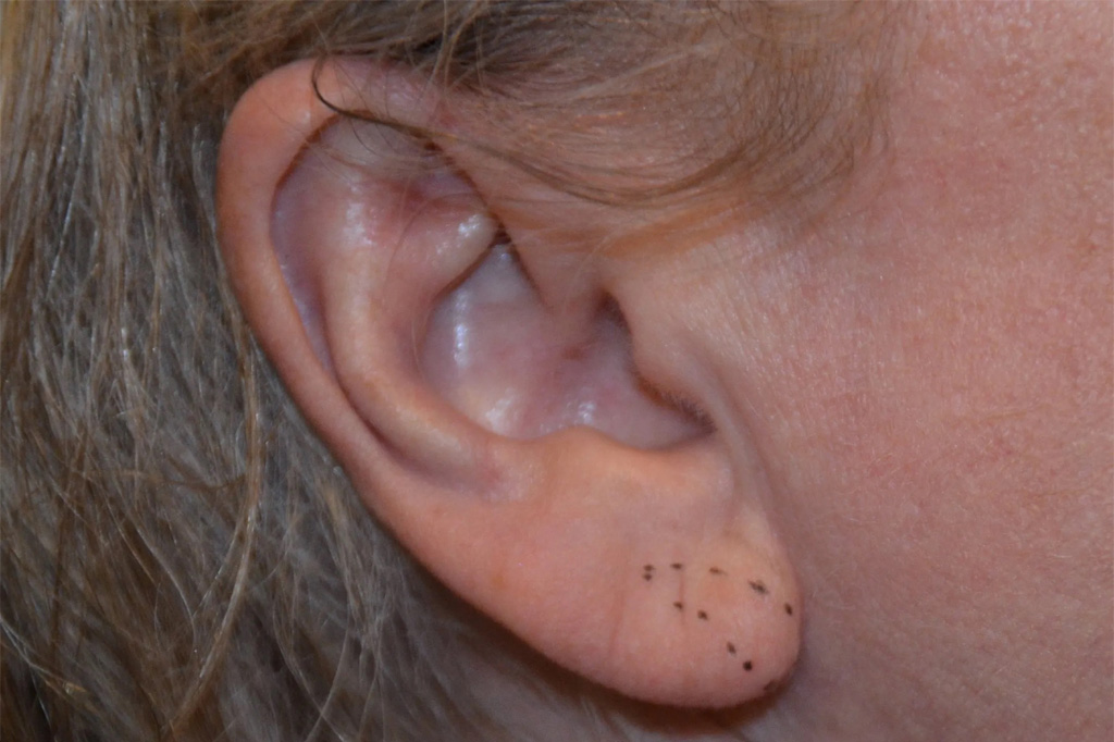 Ear Surgery Real Patient Results by Dr. Scott Urban in Salt Lake City, Utah