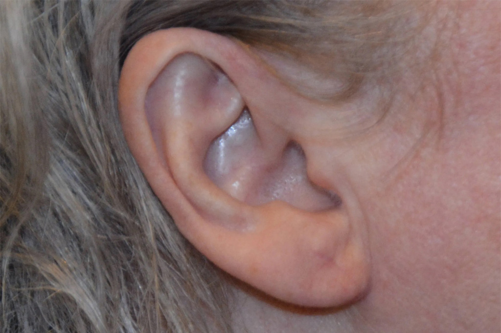 Ear Surgery Real Patient Results by Dr. Scott Urban in Salt Lake City, Utah