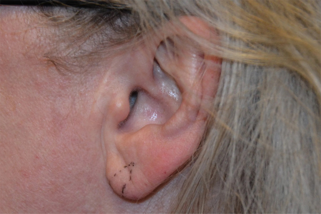 Ear Surgery Real Patient Results by Dr. Scott Urban in Salt Lake City, Utah