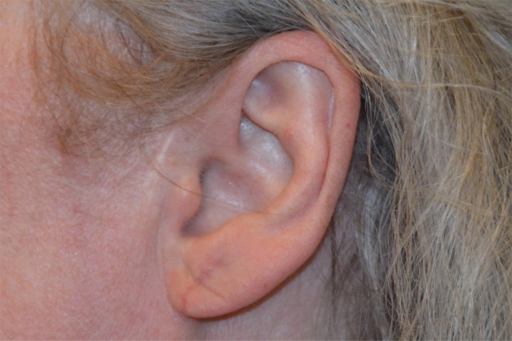 Ear Surgery Real Patient Results by Dr. Scott Urban in Salt Lake City, Utah