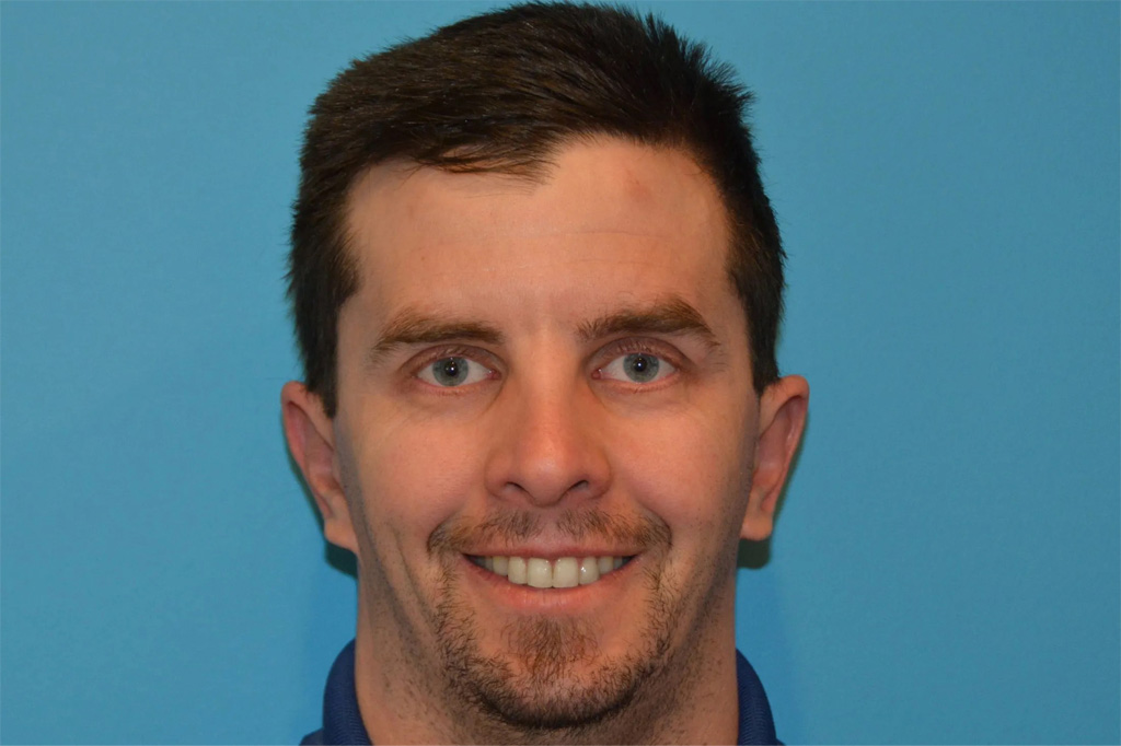 Ear Surgery Real Patient Results by Dr. Scott Urban in Salt Lake City, Utah
