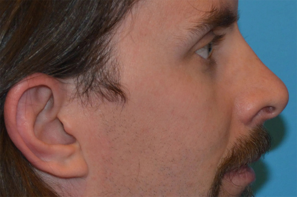 Ear Surgery Real Patient Results by Dr. Scott Urban in Salt Lake City, Utah