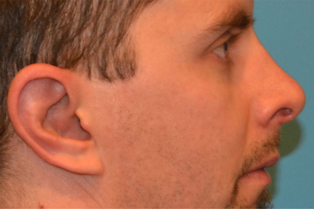 Ear Surgery Real Patient Results by Dr. Scott Urban in Salt Lake City, Utah