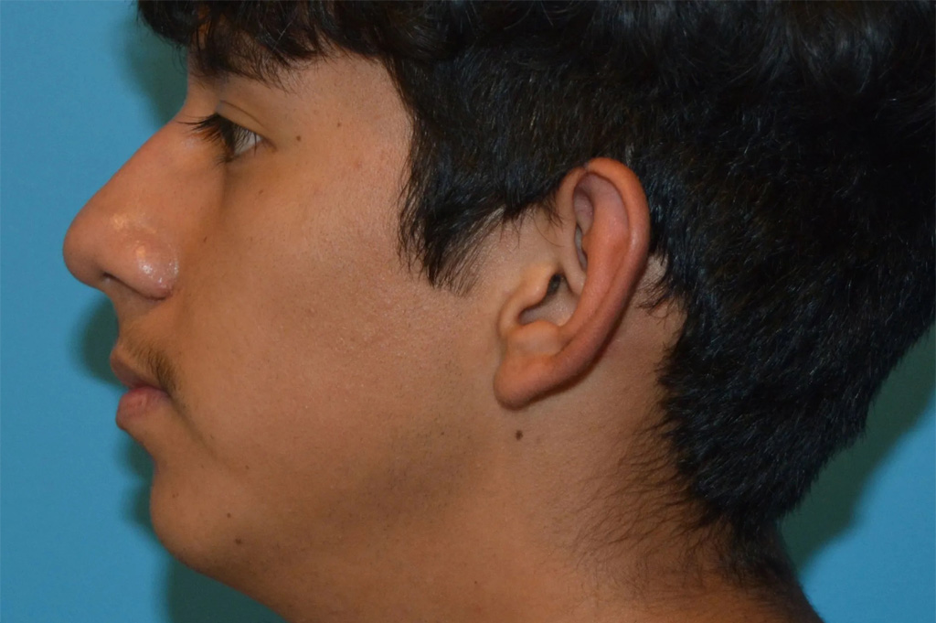 Ear Surgery Real Patient Results by Dr. Scott Urban in Salt Lake City, Utah