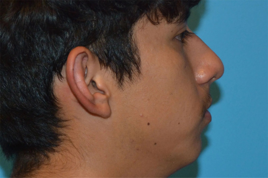 Ear Surgery Real Patient Results by Dr. Scott Urban in Salt Lake City, Utah