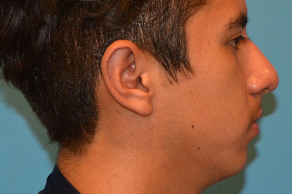 Ear Surgery Real Patient Results by Dr. Scott Urban in Salt Lake City, Utah