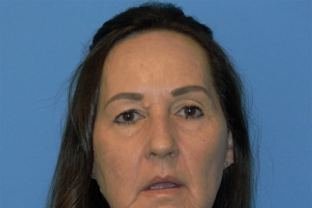 Lip Lift Real Patient Results by Dr. Scott Urban in Salt Lake City, Utah