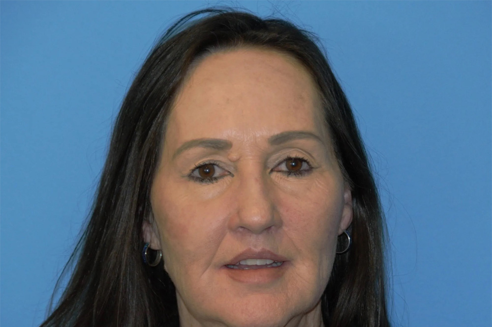 Lip Lift Real Patient Results by Dr. Scott Urban in Salt Lake City, Utah