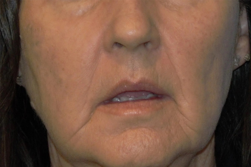 Lip Lift Real Patient Results by Dr. Scott Urban in Salt Lake City, Utah