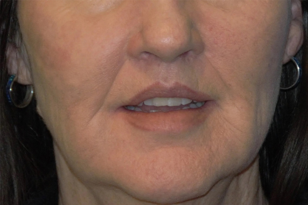 Lip Lift Real Patient Results by Dr. Scott Urban in Salt Lake City, Utah
